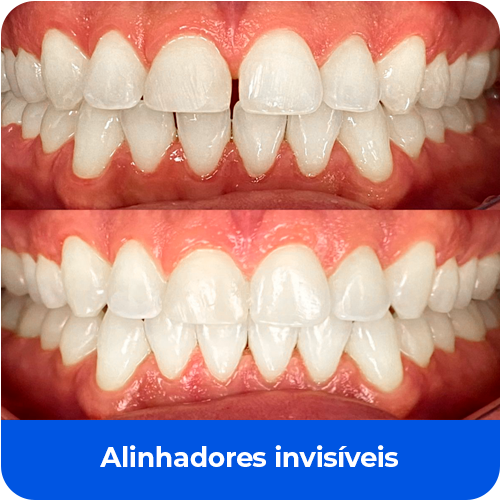 Alinhadores invisíveis