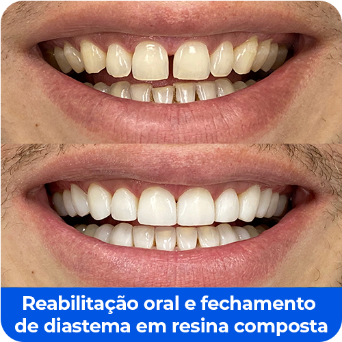 Reabilitação oral e fechamento de diastema em resina composta
