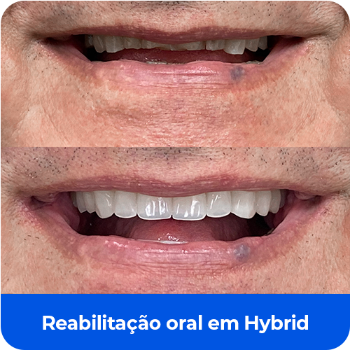 Reabilitação oral em Hybrid