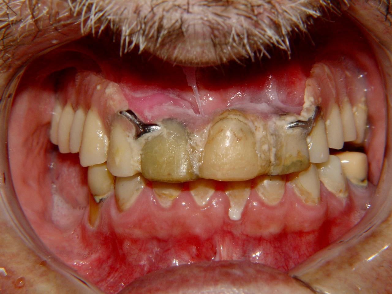 Antes