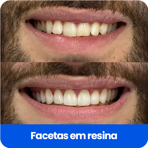 FACETAS EM RESINA1