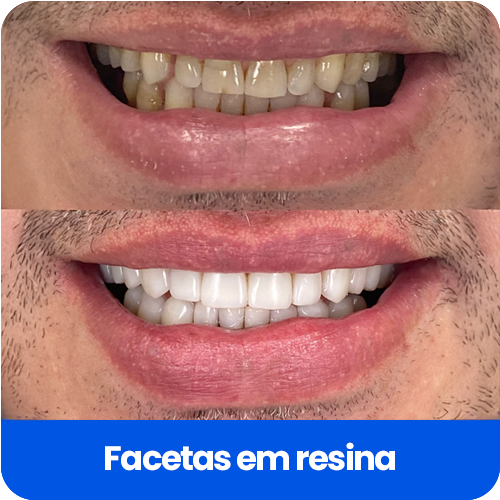 FACETAS EM RESINA2
