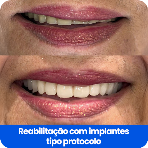 Reabilitação com implantes3