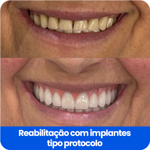 Reabilitação com implantes4