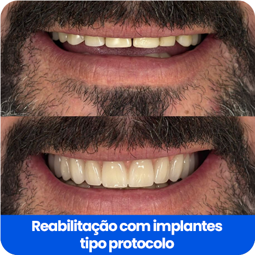 Reabilitação com implantes5