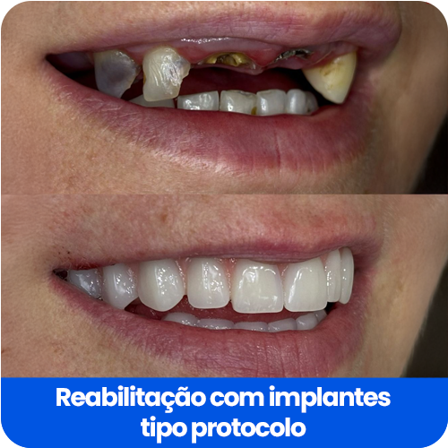 Reabilitação com implantes6