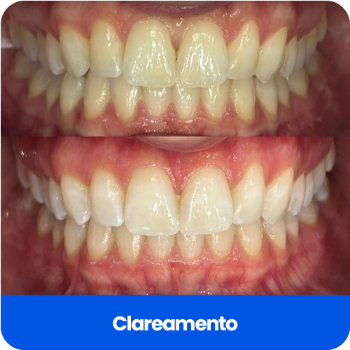 clareamento