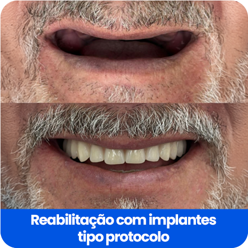 reabilitação com implantes1