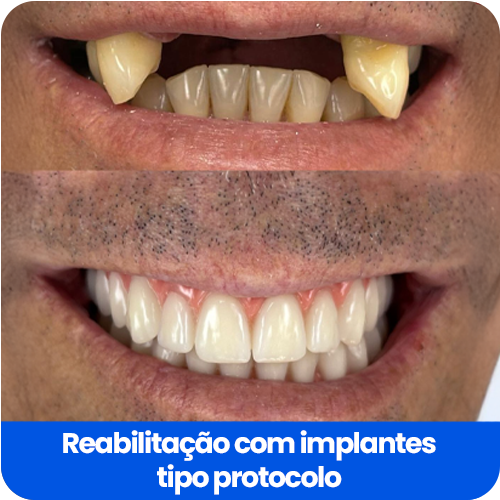 reabilitação com implantes2