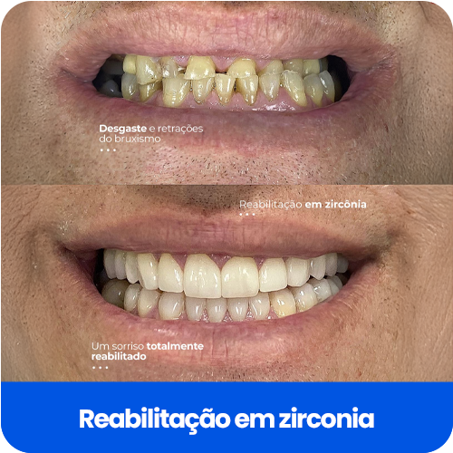 reabilitação em zirconia