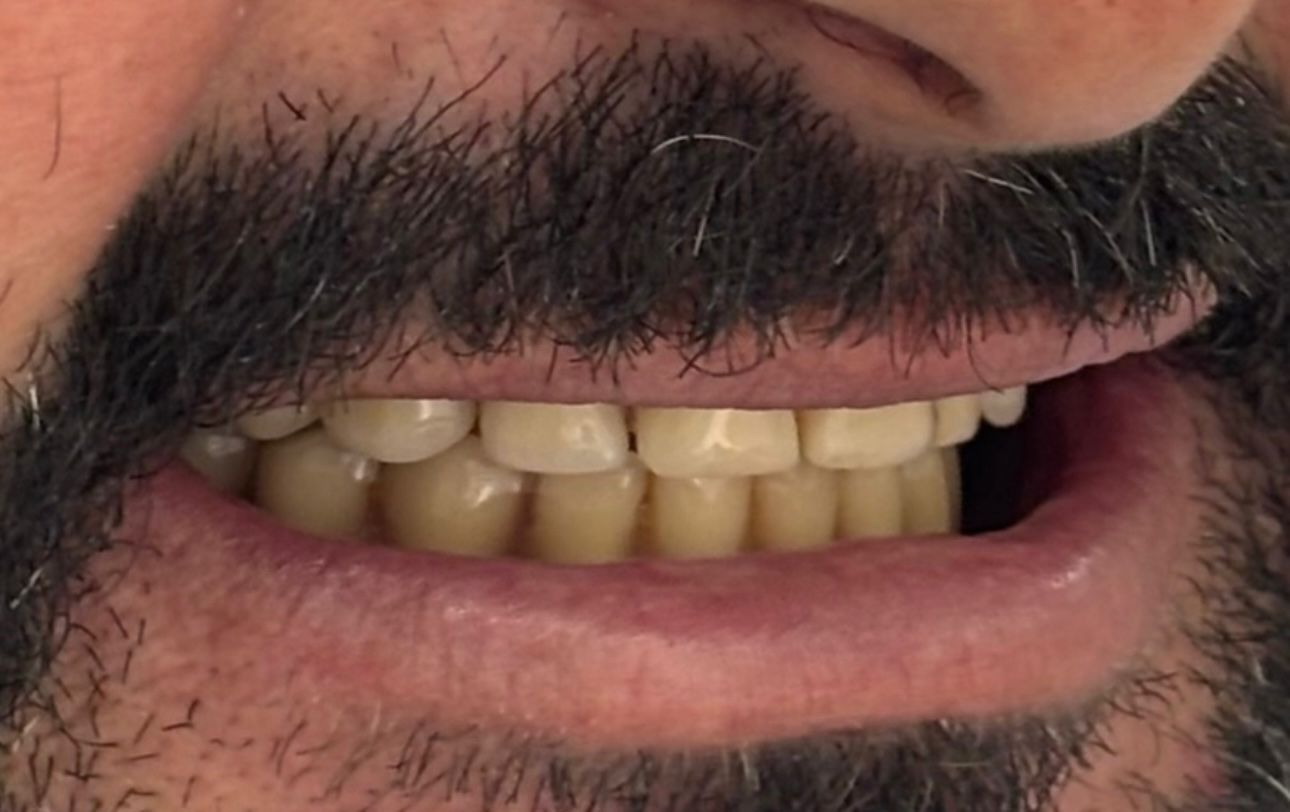 Antes